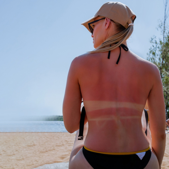 Dermatolozi upozoravaju da je trovanje suncem moguće, ovo je prvi simptom